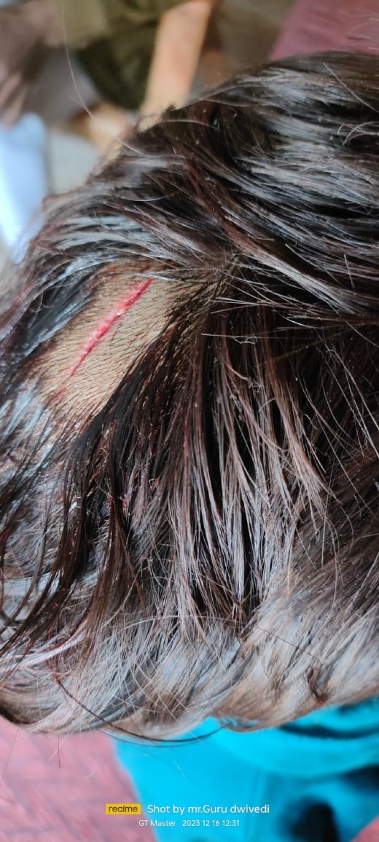 *सरस्वती ज्ञान मंदिर विद्यालय में पढ़ने वाले कक्षा 4 के छात्रा की फीस न जमा करने पर जमकर पिटाई,सिर मे लगे चार टाके।*